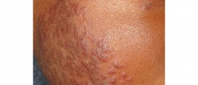 Discoid Lupus Erythematosus: Symptoms and Treatment