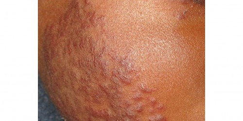 Discoid Lupus Erythematosus: Symptoms and Treatment