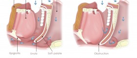 Why Specialized Care For Sleep Apnea Is Important