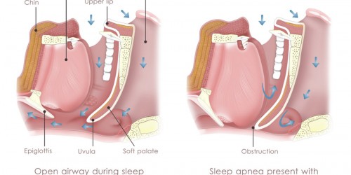 Why Specialized Care For Sleep Apnea Is Important