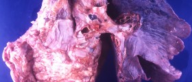 Are You A Candidate For Lung Cancer Screening?