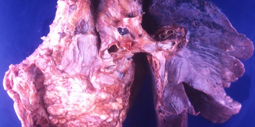 Are You A Candidate For Lung Cancer Screening?