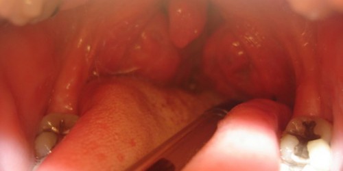 Esophagitis and Gastroduodenal Disorders: Symptoms and treatment