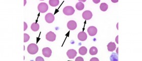 Hereditary spherocytosis