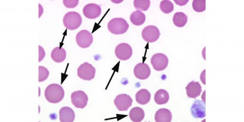 Hereditary spherocytosis