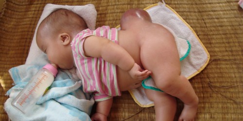 Neural Tube Defects: Spinal Bifida & Anencephaly