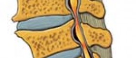 Spinal Cord Stenosis