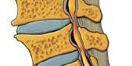 Spinal Cord Stenosis