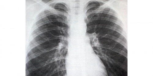 Dangers of Sternum Fracture (Breast Bone)