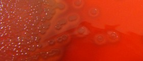 Meningococcal Disease: Meningitis treatment and prevention