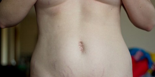 Tips on how to remove stretch marks