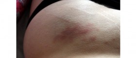 5 Tips For Minimizing Stretch Marks