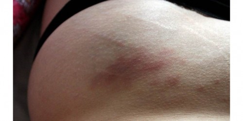 5 Tips For Minimizing Stretch Marks