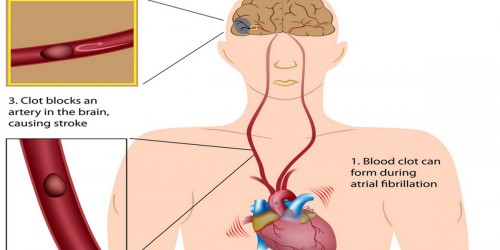 Catching Clots, Preventing Strokes