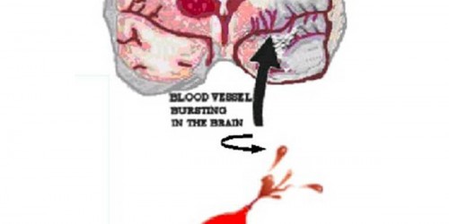 Reducing Stroke Severity With Regular Exercise