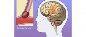 Stroke in young people