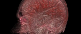 Huntington's Disease: Progressive Neurodegenerative Genetic Disorder