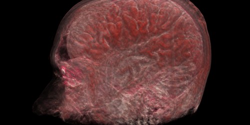 Huntington's Disease: Progressive Neurodegenerative Genetic Disorder