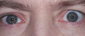 How To Treat A Stye At Home