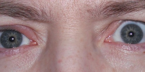 How To Treat A Stye At Home