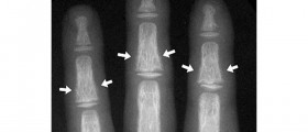 Renal Osteodystrophy