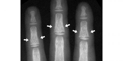 Renal Osteodystrophy