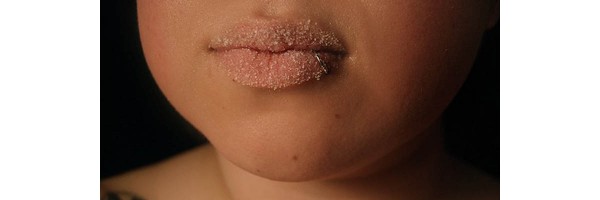 Does Eating Sugar Age Your Skin?