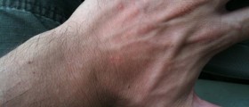 Sun Poisoning or Photodermatitis