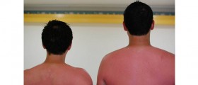 Ten Easy Home Remedies For Sunburn