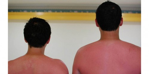 Ten Easy Home Remedies For Sunburn