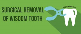 Surgical Removal Of Wisdom Tooth: What To Expect And Aftercare Tips