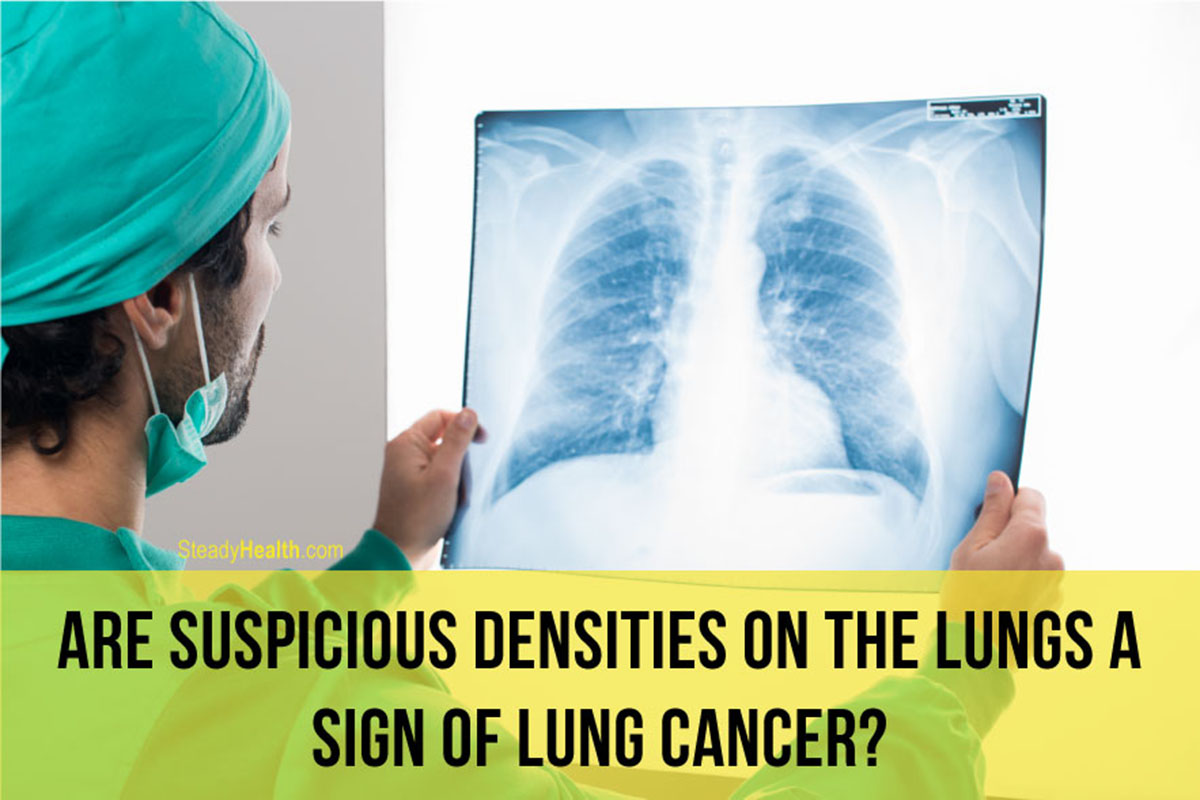 suspicious-densities-on-the-lungs-a-sign-of-lung-cancer-respiratory