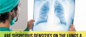 Suspicious Densities On The Lungs: A Sign Of Lung Cancer?