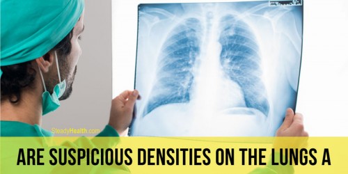 Suspicious Densities On The Lungs: A Sign Of Lung Cancer?