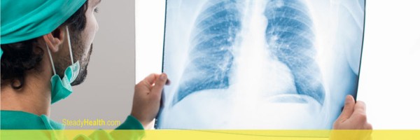 Suspicious Densities On The Lungs: A Sign Of Lung Cancer?