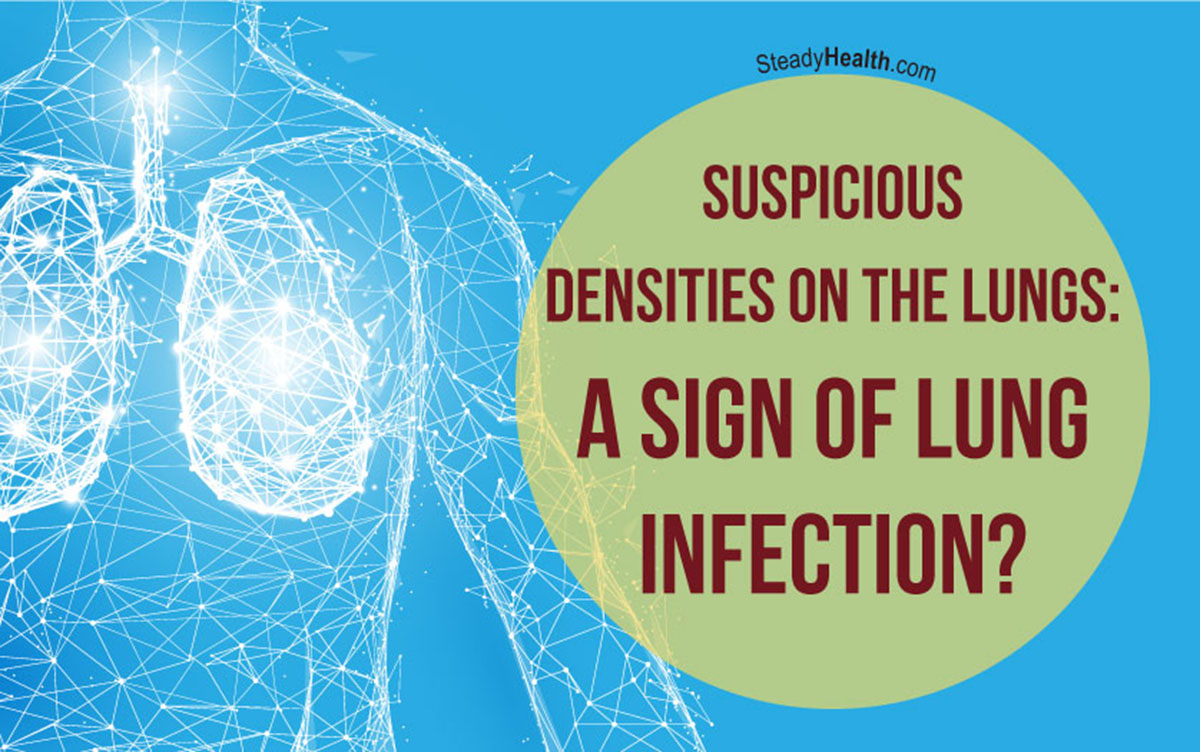 suspicious-densities-on-the-lungs-a-sign-of-lung-infection