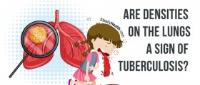 Suspicious Densities On The Lungs: A Sign Of Tuberculosis (TB)?