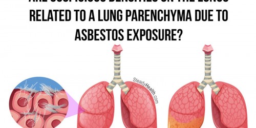 Suspicious Densities On The Lungs: Related To A Lung Parenchyma Due To Asbestos Exposure?