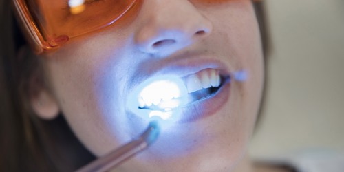 Teeth Whitening: Is it a scam?