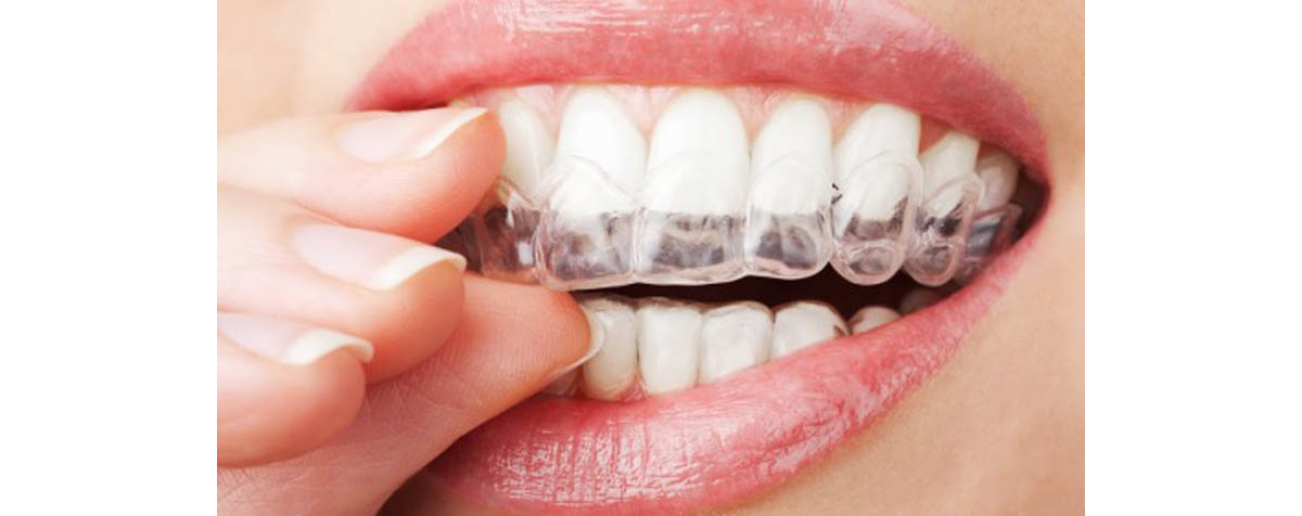 Is hydrogen peroxide teeth whitening