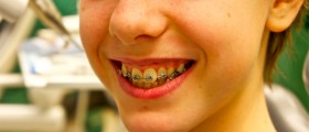 Why Do Teeth Become Crooked After Orthodontic Treatment? How Can It Be Prevented?