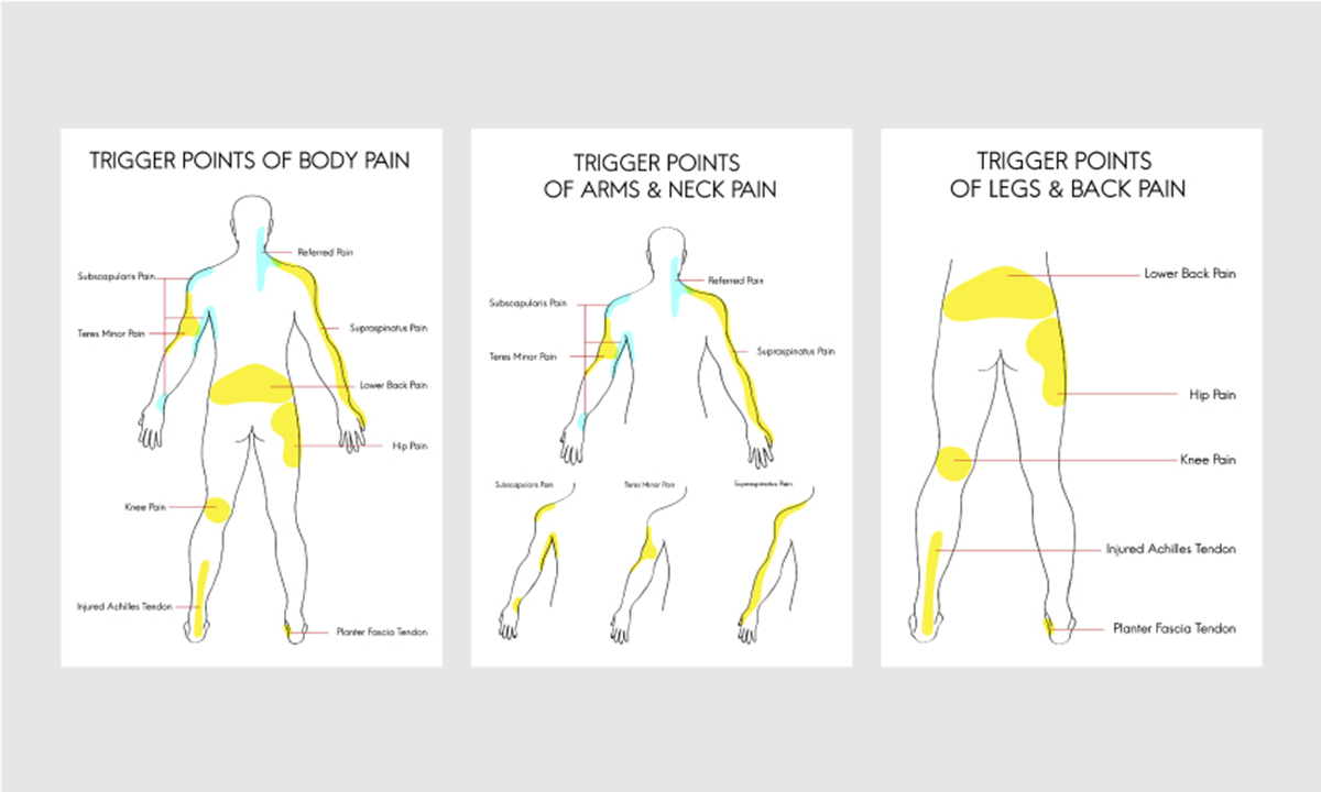 Myofascial Syndrome Trigger Points Chart