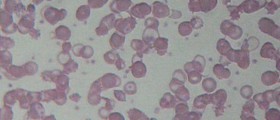 Thalassemia: What Every Parent Needs To Know About A Devastating Blood Disorder