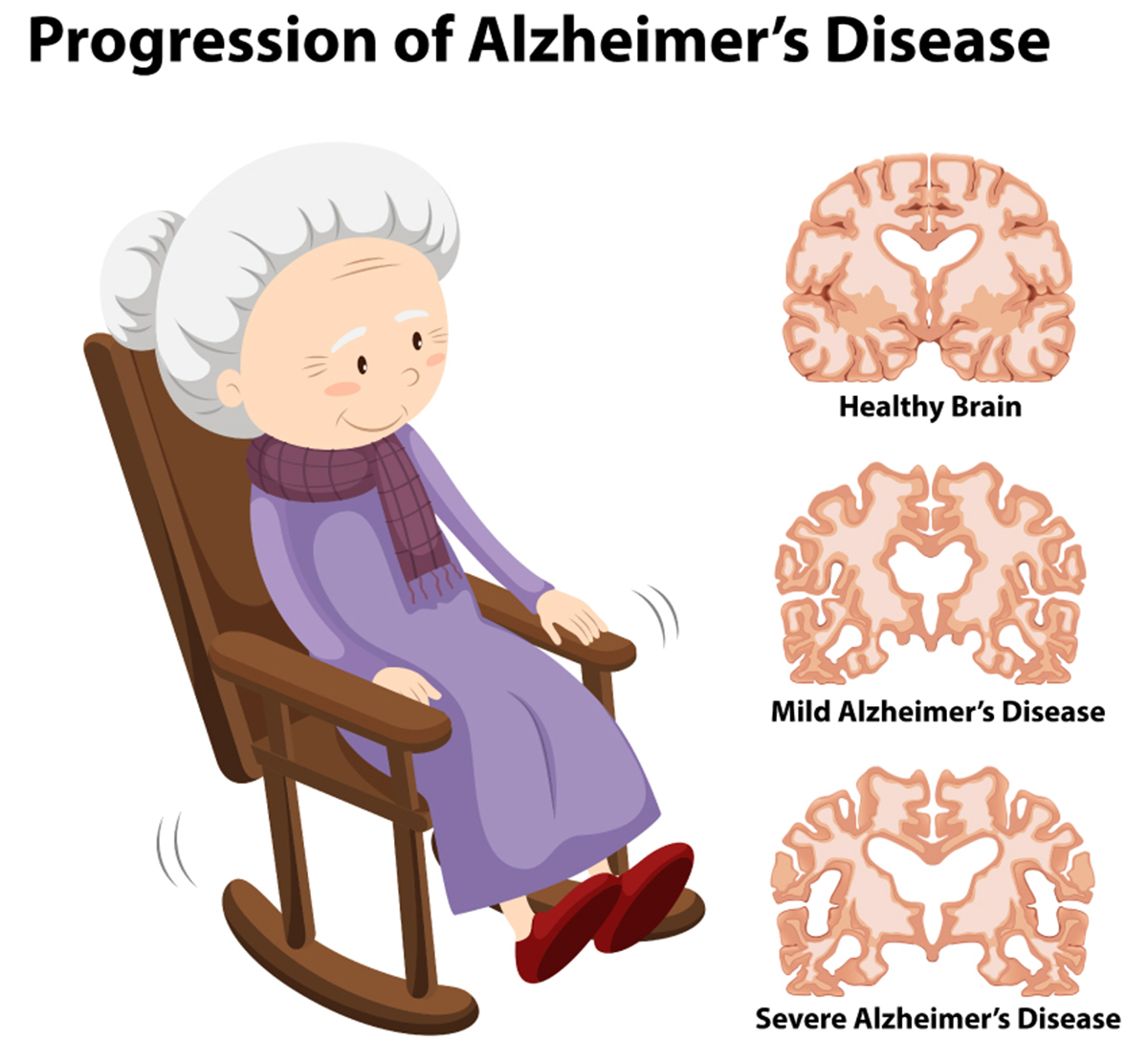 The Stages Of Alzheimers Disease How Does The Disease Progress And Can You Stop It