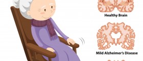 The 3 Stages of Alzheimer’s Disease: How Does the Disease Progress and Can You Stop It?