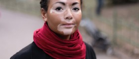 The Beauty Of Being Different: Vitiligo, Birthmarks, Albinism And Other Stunning Miracles of Nature