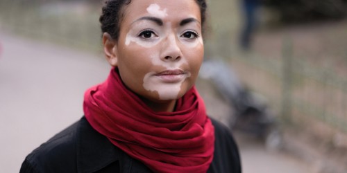 The Beauty Of Being Different: Vitiligo, Birthmarks, Albinism And Other Stunning Miracles of Nature