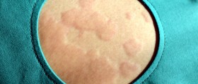 Things You Should Know About Hives (Urticaria): Causes, Symptoms And Diagnosis