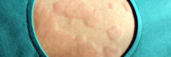 Things You Should Know About Hives (Urticaria): Causes, Symptoms And Diagnosis