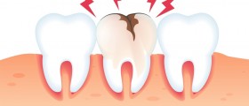 Toddler Tooth Decay: How To Treat Tooth Cavities Or Caries In Young Children?